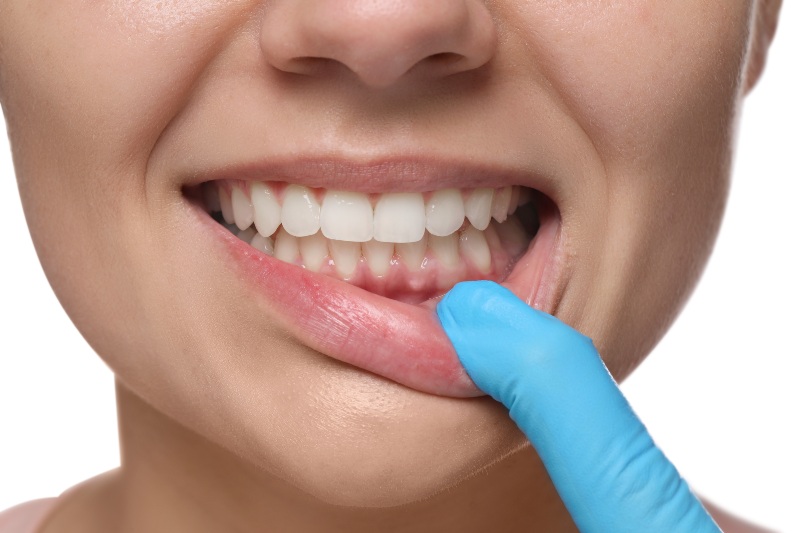 Gum contouring for a balanced smile at Elite Smiles of New Lenox, New Lenox, IL